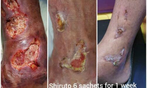 Shiruto & Befil – 腳傷口發炎和潰爛